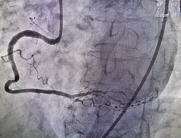 angiogram